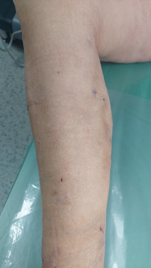 danica petrovic - skidanje konaca